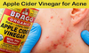 Apple Cider Vinegar: Benefits, uses, For Treatment Of Infections.